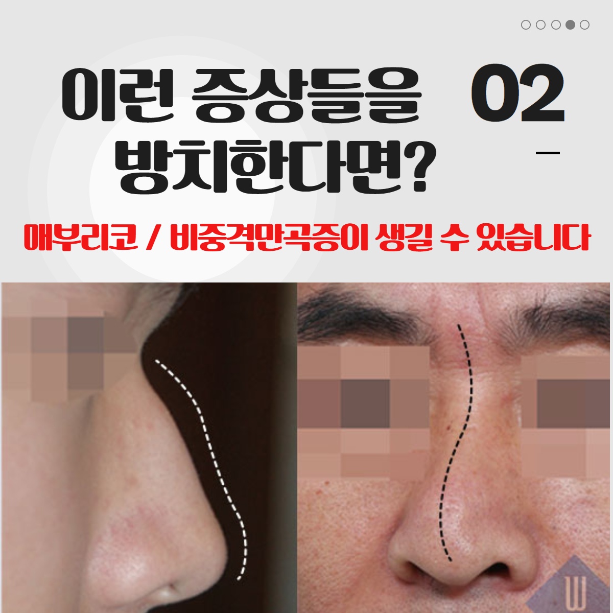 [수원 성형외과] 코 뼈 골절 성형외과로 가야 하는 이유는? (4/10)