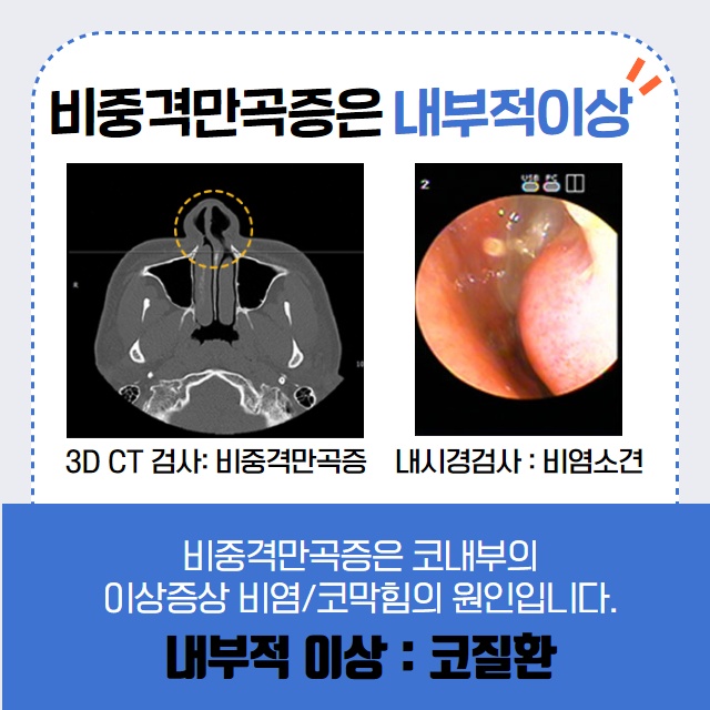 콧물이 주르륵 비염 코 세척과 비염치료. (8/14)