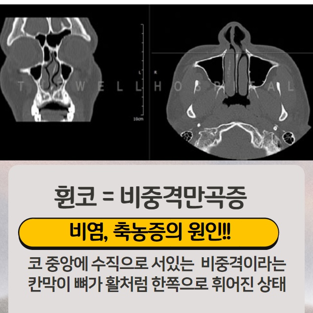 코가 휘어지고 비뚤어진 원인! (3/10)