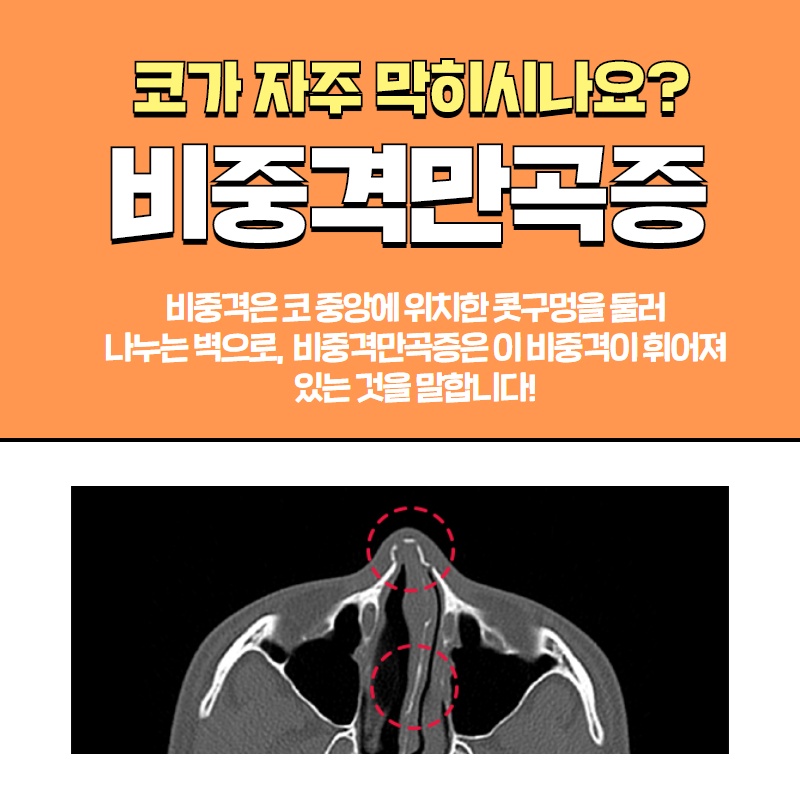휜코, 비중격만곡증 보험 적용받아 저렴하게 하는 방법! (2/10)