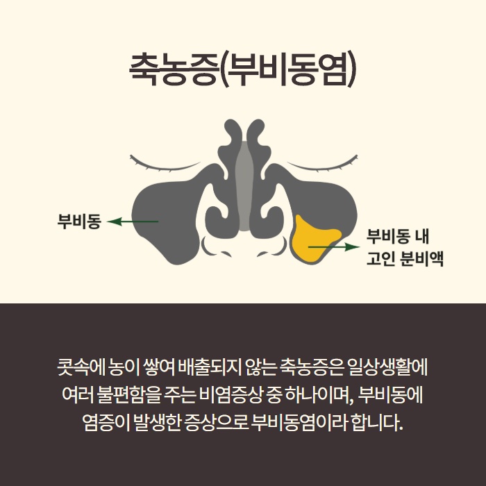 감기와 부비동염 (축농증)의 차이! 원인과 치료방법. (2/11)