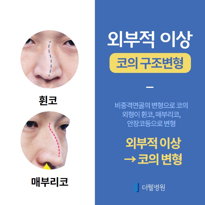 숨을 쉬기가 힘들어요! 비중격 만곡증이란? (4/10)
