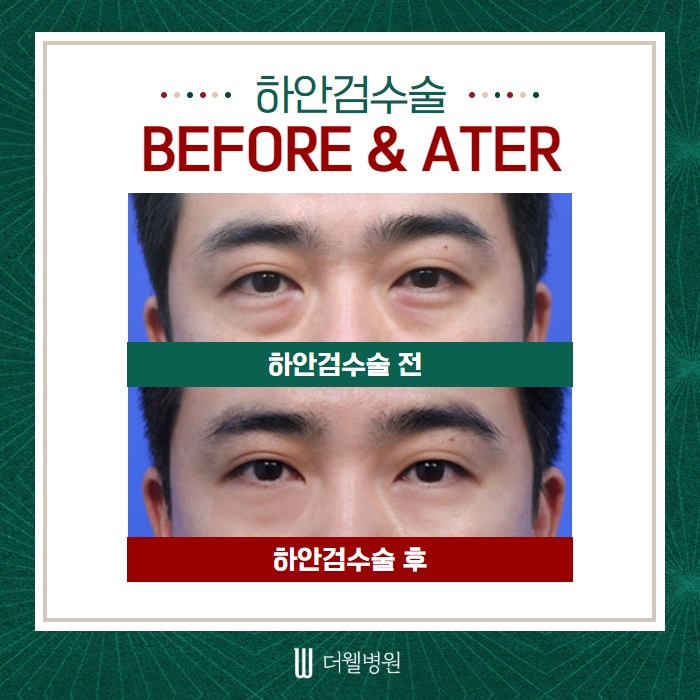 노화의 시작! 눈 밑처짐... 하안검 수술에 대해서 알아볼까요? (8/10)