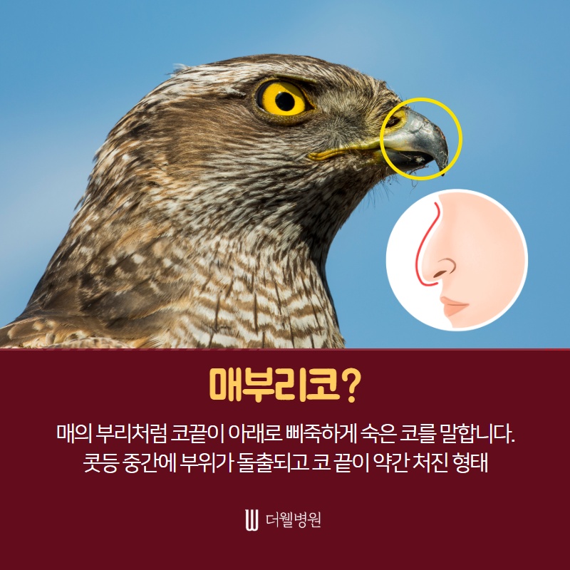 매부리코 수술, 코막힘까지 해결하자! (2/10)