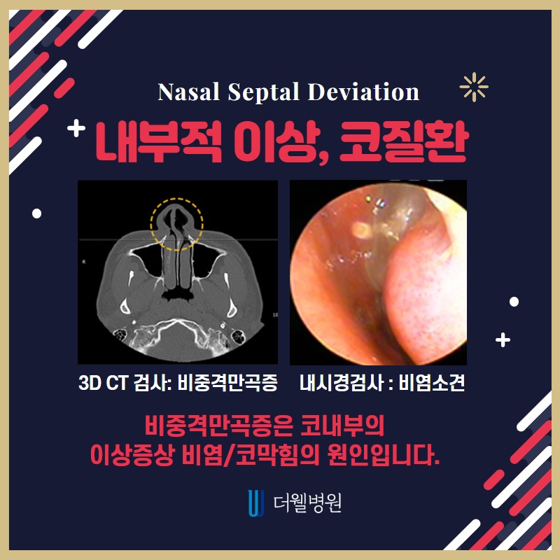 코막힘의 원인, 비중격 만곡증 (3/10)