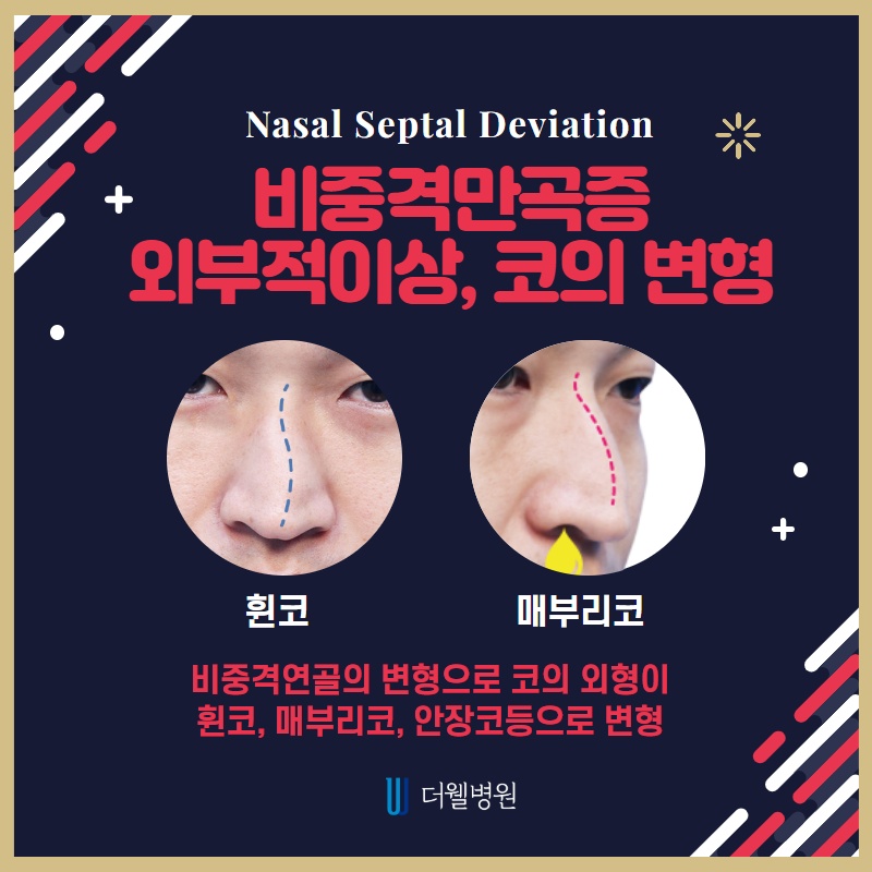 코막힘의 원인, 비중격 만곡증 (5/10)