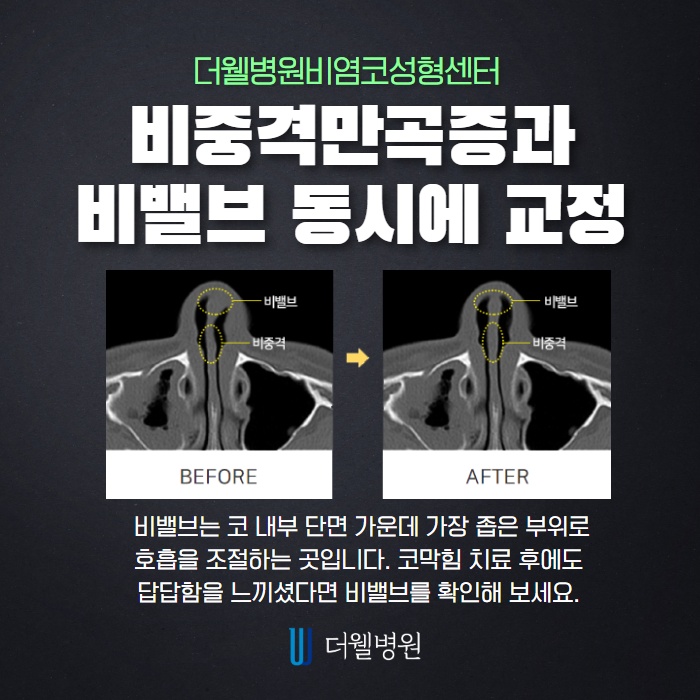 비염코성형, 비염과 코성형을 동시에?! (4/9)