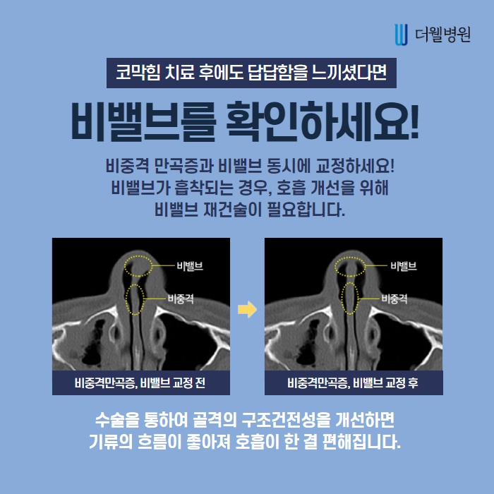 비중격만곡증, 수술로만 치료가 가능할까? (6/11)
