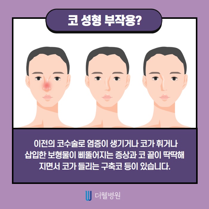 코 재수술 키포인트는? (2/10)