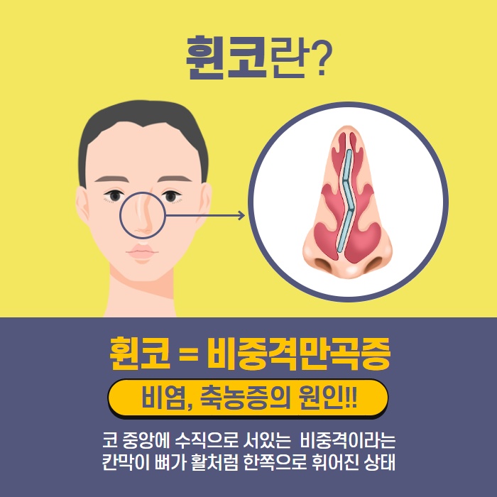 휜 코 성형! 코 내부문제까지 해결해야! (2/9)