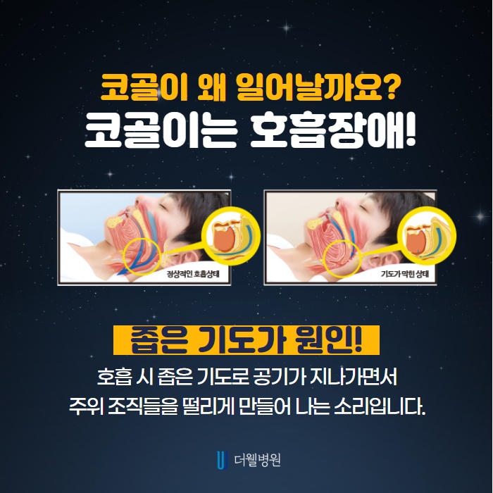 옆 사람 피해주는 코골이, 수면무호흡증 수술 안하는 방법은? (3/11)
