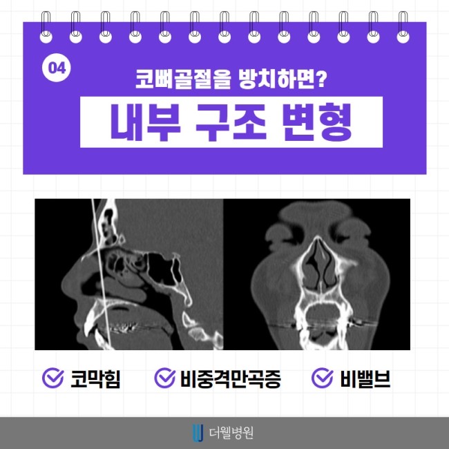 코 뼈 골절은 치료시기가 중요해요! (5/10)