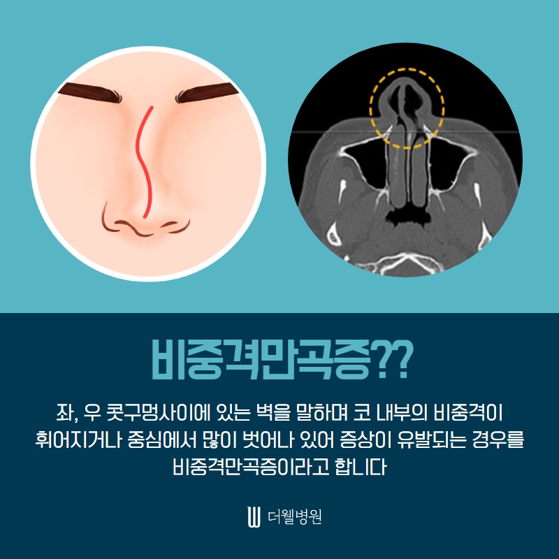 매부리코 수술, 코막힘도 확인하세요! (4/9)