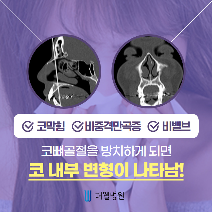 코 뼈 골절 빠른 시기에 치료해야합니다! (5/10)