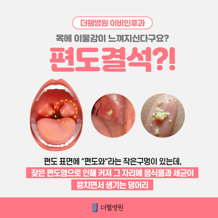 심한 입냄새의 원인!! "편도결석" (2/10)