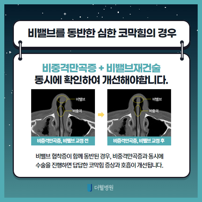 코막힘 이제 날려버려! (4/10)