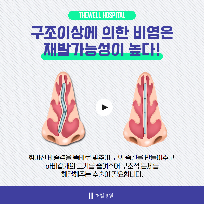 비염방치하면 치매가 올 수도 있다?! (5/10)