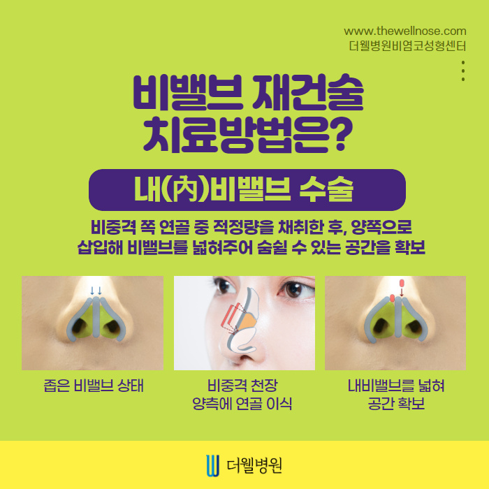 만성적인 코막힘 비밸브재건술로! (4/9)