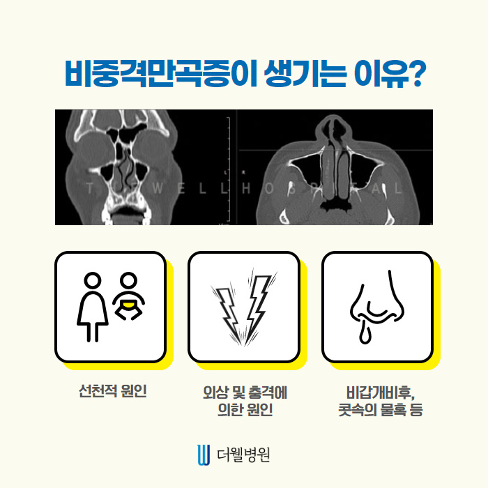 휜코 성형 시 비중격만곡증 동시에 개선!! (3/10)