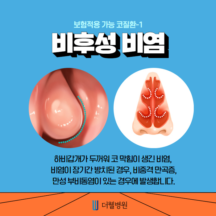 비염수술과 코성형은 무슨관계가 있나요? (3/11)