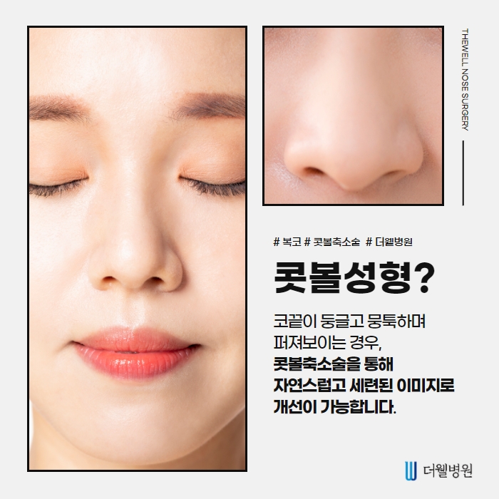 더웰병원 콧볼 축소술