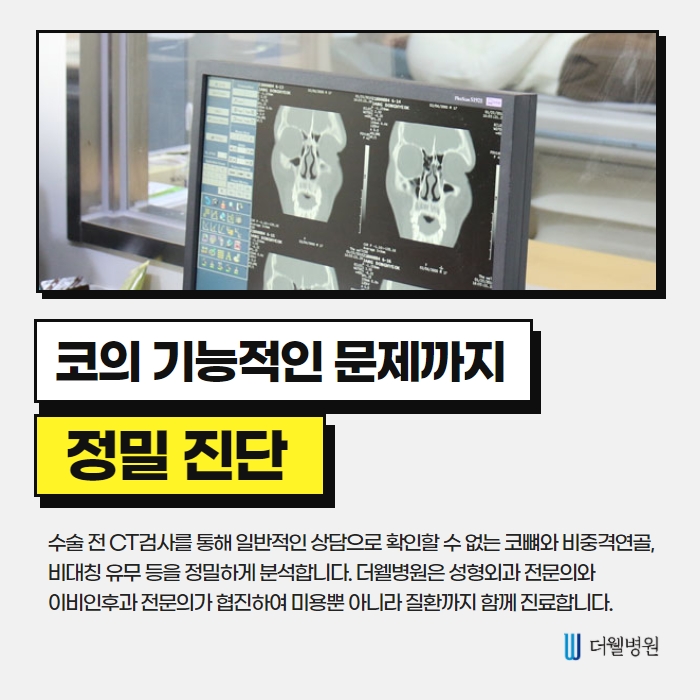 더웰병원 콧볼 축소술