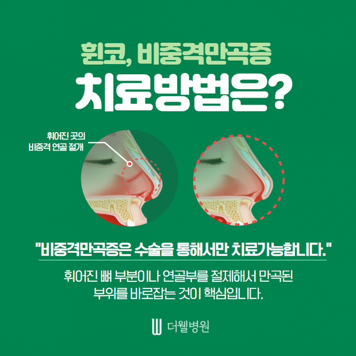 더웰병원 휜코 교정